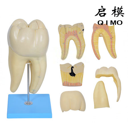磨牙蛀牙解剖放大模型